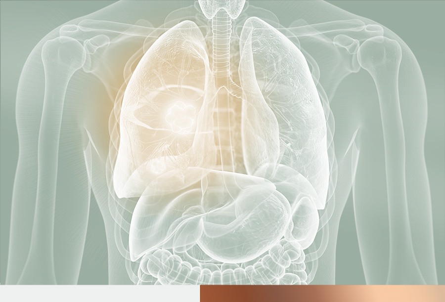 lung cancer screening london